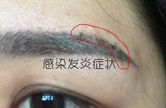在这几养生会馆做过 纹眉的顾客,术后大部分都出现了发炎,感染和