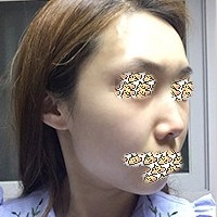 韩国然美之整形医院鼻综合案例手术前后对比，变化大！